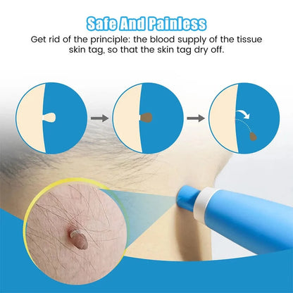 Manual Wart Removal Device At Home